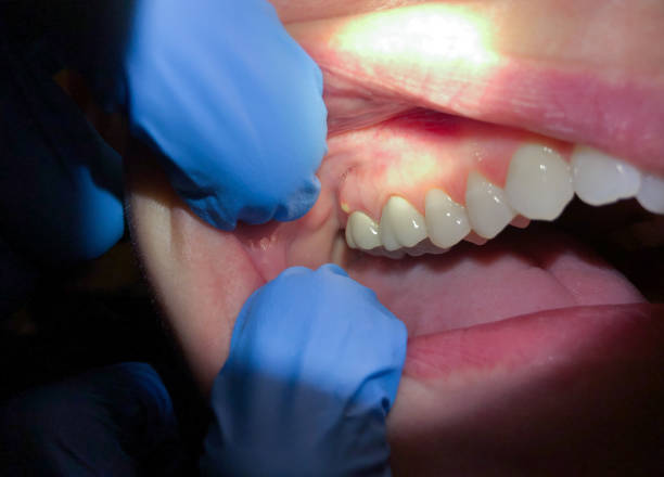 Best Emergency Gum Treatment in South Berwick, ME